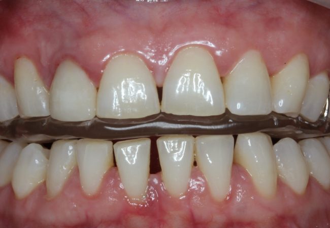 Occlusal Sprints for Teeth Grinding