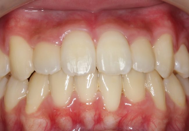 Ortho Case 8 - After Front