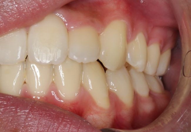 Ortho Case 8 - After Front