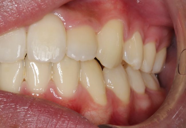 Ortho Case 8 - After Front