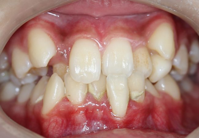 Ortho Case 8 - Before Front