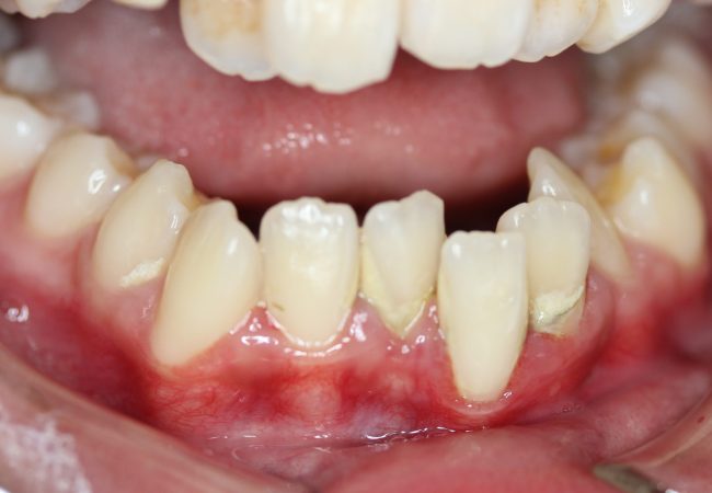 Ortho Case 8 - Before Lower