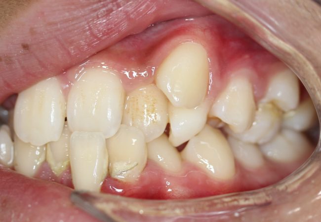 Ortho Case 8 - Before Side