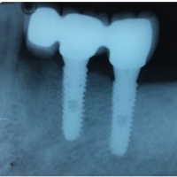implant supported x-ray