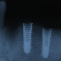 x-ray of placed implants