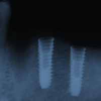 x-ray of placed implants x-ray of placed implants